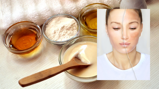 Skin Purging Explained (and What to Do About it)